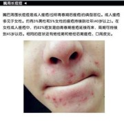 孕期下巴长痘（孕期下巴长痘痘是什么原因造成的）