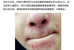 孕期下巴长痘（孕期下巴长痘痘是什么原因造成的）