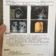 胎儿腹腔囊性包块（子宫囊性包块怎么办）