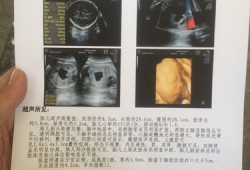 胎儿腹腔囊性包块（子宫囊性包块怎么办）