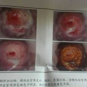 怀孕期间宫颈炎症状（宫颈炎早期症状有哪些）