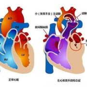 胎儿左心发育不良（胎儿左心发育不良还能要吗）