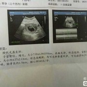 一般怀孕多少天可以看见孕囊呀，通过孕囊大小可以判断出男女吗,胎囊就是胎儿吗?