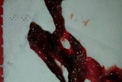 孕期宫腔出血（孕期宫腔出血是什么原因）