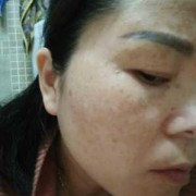 怀孕后期脸上长斑是怎么回事了,孕期长斑图片大全