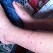 孕妇身上起紫癜影响胎儿健康吗,孕期紫癜是什么意思