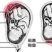 前置胎盘对胎儿的影响（前置胎盘对胎儿的影响有哪些）