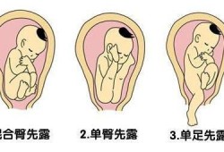 孕期正常胎位（怀孕多少周定胎位最好？怎样才能够胎位正常）