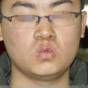 第一胎兔唇第二胎的几率是多少,胎儿兔唇几率大吗