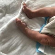 胎儿右脚内翻（新生儿轻微脚内翻是怎么回事呢）