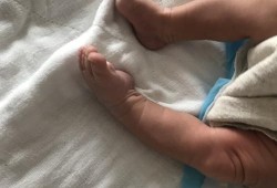 胎儿右脚内翻（新生儿轻微脚内翻是怎么回事呢）