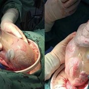 怀孕32周提前剖腹产宝宝能存活吗？我不知道应该要怎么办才好,32周的胎儿能存活吗?