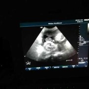 怀孕32周胎儿腹中视频（手机存储卡的视频无法播放）