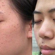 孕期扁平疣（我于怀孕期间在脸，胸部长了一些丝状疣和扁平疣，怎么办）