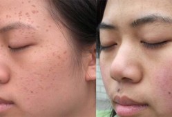 孕期扁平疣（我于怀孕期间在脸，胸部长了一些丝状疣和扁平疣，怎么办）