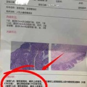 孕期宫颈增生（宫颈鳞状上皮增生怎么治疗）