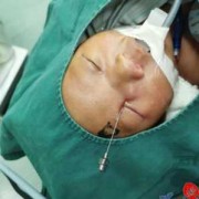 胎儿泪囊肿算畸形吗（胎儿泪囊肿算畸形吗）
