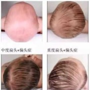 胎儿的头是扁的正常吗（胎儿的头是扁的正常吗）