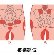 孕期屁股疼（孕妇臀部疼痛是怎么回事）