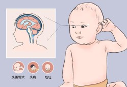 胎儿脑积水会怎么样（胎儿脑积水怎么样会自己吸收吗）