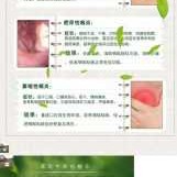 孕期喉咙发炎怎么办,怀孕期间咽炎犯了怎么办