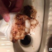 孕期吐出血（孕妇怀孕孕吐的时候吐出血怎么办好呢）