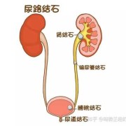 哺乳期肾结石怎么办,胎儿肾结石是怎么形成的
