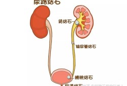 哺乳期肾结石怎么办,胎儿肾结石是怎么形成的