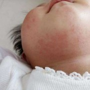 妊娠湿疹对胎儿的影响（妊娠湿疹对胎儿的影响）