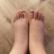怀孕期间腿肿怎么回事（怀孕几个月开始腿脚肿）