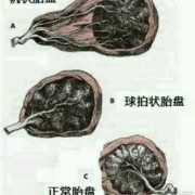 帆状胎盘的胎儿能要吗（帆状胎盘对胎儿有影响吗）