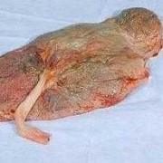 孕妇羊水脏影响胎儿是什么,胎儿吸入胎粪会怎么样有后遗症吗?