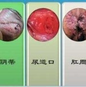 孕期尖锐湿疣怎么治疗（孕妇尖锐疣湿怎么治疗）