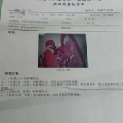 什么是泰纳检验,孕期活检是什么