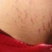 孕期没长妊娠纹生完会有吗（为什么有的女人没有妊娠纹）