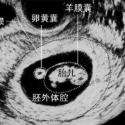胎儿卵黄囊（胎儿卵黄囊什么时候出现）