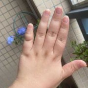 胎儿手偏短（胎儿手偏短是什么原因）