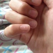 孕期长白斑（指甲上有白斑是怎么回事）