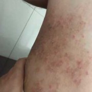怀孕期间腿痒（怀孕期间腿痒怎么办特别是在晚上 越抓越痒）