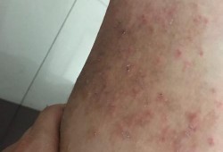 怀孕期间腿痒（怀孕期间腿痒怎么办特别是在晚上 越抓越痒）