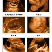 胎儿系统彩超（胎儿系统彩色多普勒超声检查是什么意思）
