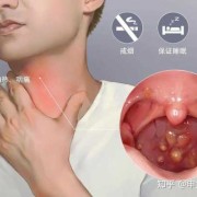 孕期咽喉炎咳嗽厉害怎么办,孕妇咽炎对胎儿有影响吗
