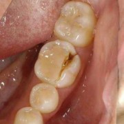 牙齿裂怎么办,孕期牙碎了怎么办