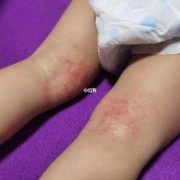 孕妇出湿疹怎么办,吃什么缓解孕期湿疹最有效
