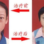 甲亢对胎儿的影响有哪些,老公有甲亢影响胎儿吗