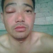 孕期眼肿（孕期眼肿）