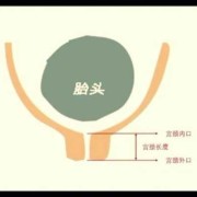 孕5个月宫颈长度短怎么办,孕期宫颈短怎么长上去