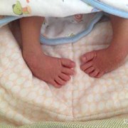 胎儿双足内翻图片（胎儿双足内翻图片大全）