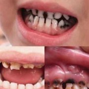 孕妇龋齿对胎儿影响（孕妇龋齿对胎儿影响大吗）