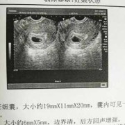 看胚胎形状测胎儿男女（看胚胎形状测胎儿男女准吗）